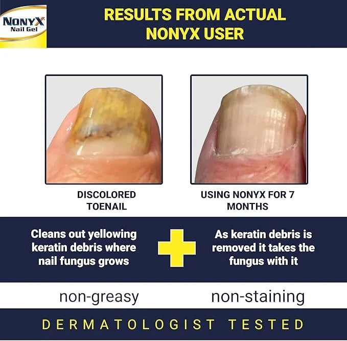 NONYX Fungal Nail Clarifying Gel 90% of 4 oz