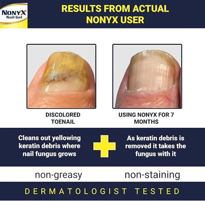 NONYX Fungal Nail Clarifying Gel 90% of 4 oz