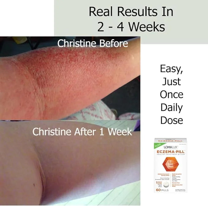 Eczema Pill – Natural Eczema Treatment – Dermatologist Developed – 7 All Natural Minerals Clear & Prevent Eczema Scaling, ...