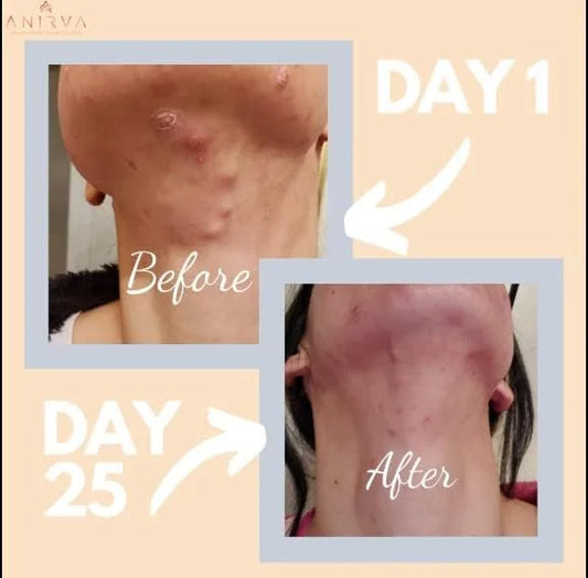 Clear Skin Supplement with Zinc for Adults, Formulated To Battle Hormonal Acne, Zinc Pills for Acne, Rosacea Skin Suppleme...