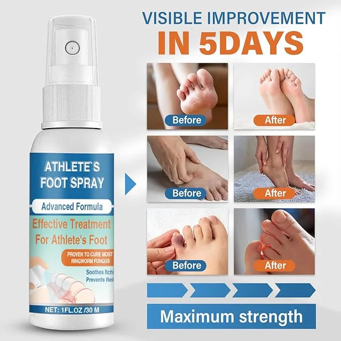 Dijkoo Athletes Foot Treatment Spray, Powerful