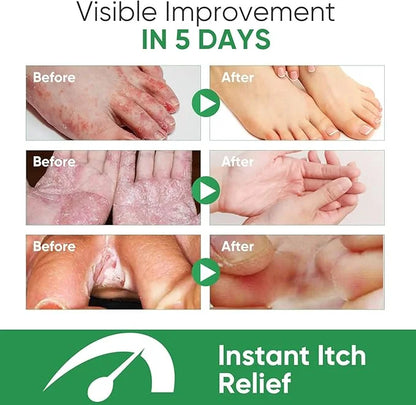 Athletes Foot Spray, Natural & Powerful