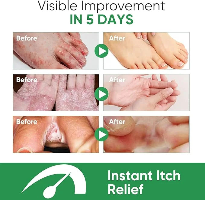 Athletes Foot Spray, Natural & Powerful