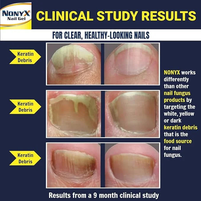 NONYX Fungal Nail Clarifying Gel 90% of 4 oz